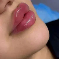 آفر ویژه مدل لب، چانه ،گونه ،بوتاکس، آنزیم بینی و