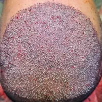 کاشت مو ی تغییر اساسی