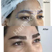 کاشت ابرو با قیمت منصفانه و بهترین مِتُد و کیفیت