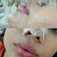 ژل فیلر اودری