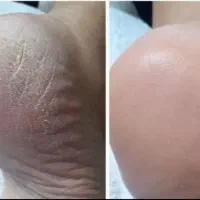 ترک پا|آرایشی، بهداشتی، درمانی|دابودشت, |دیوار