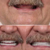 ایمپلنت اقساطی / بدون درد