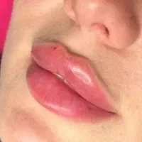 ژل بوتاکس چالگونه پرسینگ و اموزش حرفه ای