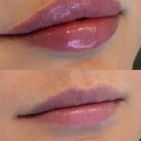 خدمات ژل و بوتاکس و مزو