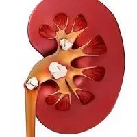 دفع سنگ کلیه بدون سنگ شکن