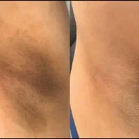 سفید کننده قوی پوست صورت و بدن