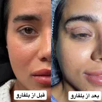 عمل بلفاروپلاستی طی ۳ قسط