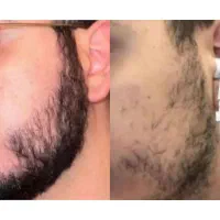 خداحافظی با ریش کمپشت