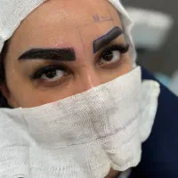 کاشت ابرو در بابل