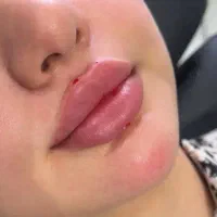 تزریق فیلر و بوتاکس نچرال با جدترین تکنیک ها
