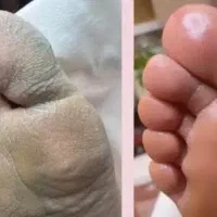 پا درمانی فقط فقط ۵۰۰ هزار تومان