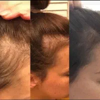 هرچه سریعتر برای ریزش موهای خود اقدام کنید