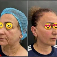 سوپر لیفتینگ نخ plcl تضمین شده توسط استاد دانشگاه