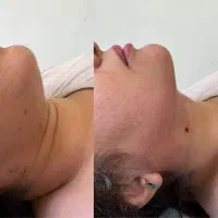 تخفیف ۵۰ درصد ساکشن غبغب یاسوج