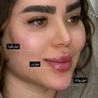 تخفیف ویژه ژل فیلر و بوتاکس و مزوژل وجوانسازدر مطب