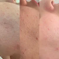 تخفیف استثنایی فیشال تخصصی،اپلاسیون،لیفت ابرو