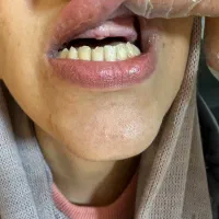دندان مصنوعی /دندانسازی/ژله ای/ با اعطای وام بانکی