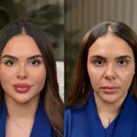 اموزش صفر تا صد ژل و بوتاکس فقط 3/500