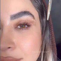 بلفاروپلاستی توسط فوق تخصص چشم(نقد و اقساط)
