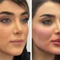 جشنواره تخفیف ژل وفیلر