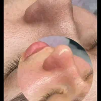 پاکسازی تخصصی و اصولی پوست