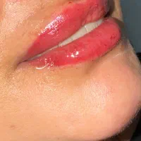 تزریق فیلر لب گونه چونه زاویه و پکیج فول فیس