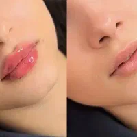 تخفیف ویژە تا دهم فیلر ، بوتاکس، مزو جوانساز،prp