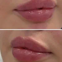 کانتورینگ صورت فقط سیسی ۸۹۰توسط پزشک متخصص