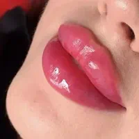 تزریق فیلر