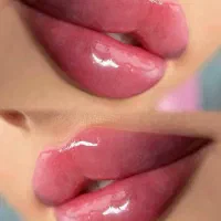 ژل لب-فیلر لب-بوتاکس(فیلر لب روسی)