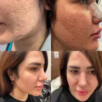 تزریق چربی ،ساکشن غبغب ،بلفاروپلاستی،تزریق ژل