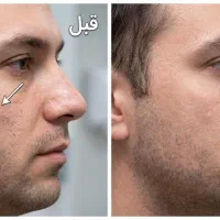 برداشت انواع خال،لک،زگیل و ضایعات پوستی یک جلسه