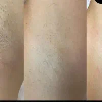 لیزر مو زائد با ۸ سال سابقه
