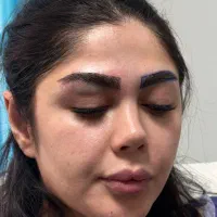 تخفیف کاشت مو کاشت ابرو میکروگرفت