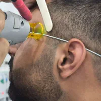 لیزر موی زائد باکندلا اصل آمریکا