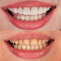 لمینیت،کامپوزیت،روکش،بلیچینگ