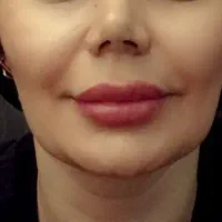 اولین مرکزپیرسینگ تخصصی وحیدیه وتزریق ژل