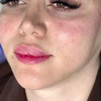 تزریق ژل وبوتاکس