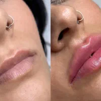 تزریق ژل لب و بوتاکس بدون سوزن(بدون درد و خونریزی)