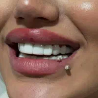لمینت متحرک دندان