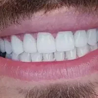 ایمپلنت دندان کره ای با روکش 15/600 تومان بدون درد