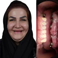 ایمپلنت ۶۵۰۰ باضمانت ۱۵ ساله