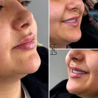 تخفیف ویژه فیشال، بوتاکس، PRP،لیزر