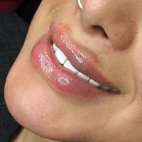 آموزش و خدمات ژل و بوتاکس