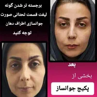 لیزر تزریق بوتاکس ژل فیلر مزوتراپی هایفو توسط پزشک