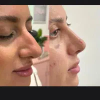 جراحی بینی،پلک،لیپوماتیک وترانسفر
