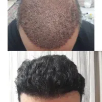 کاشت مو با تراکم بالا و قیمت استثنایی (فول تراکم)