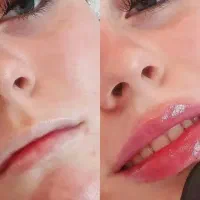 مدل جهت تزریقات فیلر