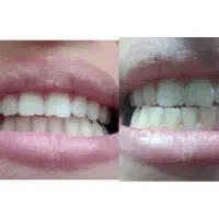 رفتن زردی دندونات با اسپری