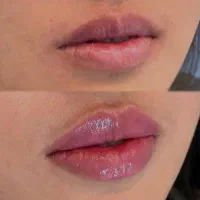 لیزر موهای زائد،تزریق ژل،بوتاکس،مزوتراپی